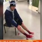 ‘Covered in blood’: Teen’s warning after shattering legs for social media trend