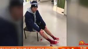 ‘Covered in blood’: Teen’s warning after shattering legs for social media trend